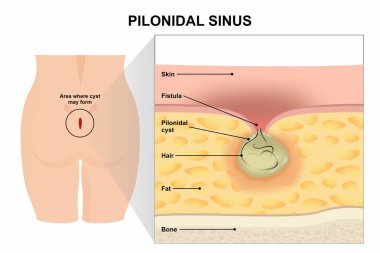 Pilonidal sinus disease vector illustration clipart