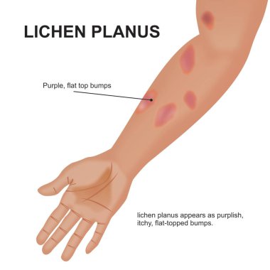 Lichen ruber planus deri çizimi