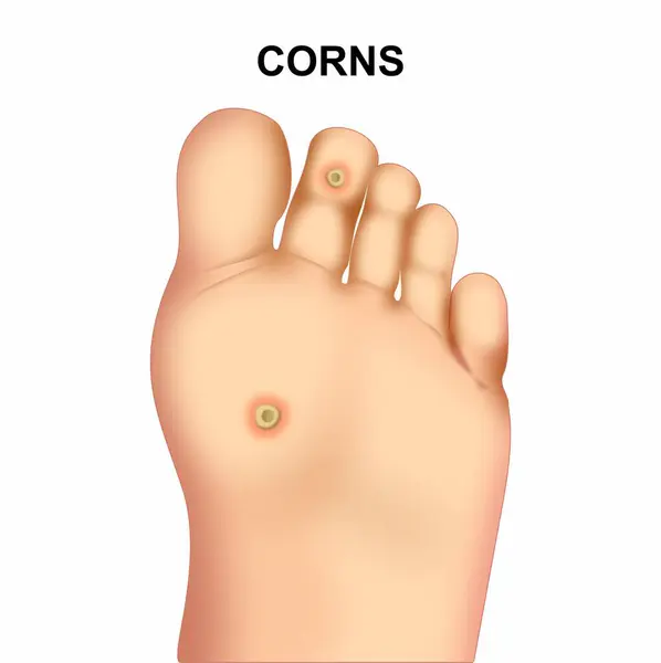 stock vector Foot Corns Medical Illustration