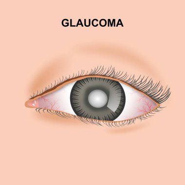 Glaucoma Göz İllüstrasyonu Gerçekçi Göz