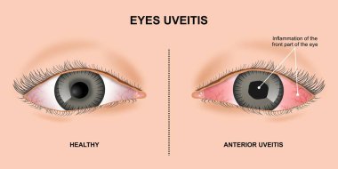 Uveitis Gözleri İltihaplandırma İllüstrasyon Gerçekçiliği