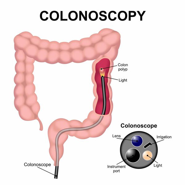 Colonoscopy instrument with cross-section illustration