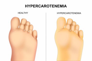 Hiperkarotenemi (Carotenosis) ayak örnekleme karşılaştırması 