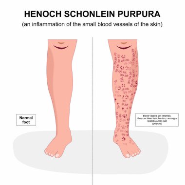 Henoch schonlein purpurpura bacak çizimi üzerine