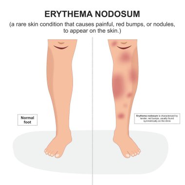Bacak illüstrasyonunda eritem nodosum