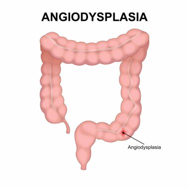 Gastrointestinal bölgede anjiyoplazi vasküler anormallik