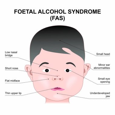 Fetal Alkol Sendromu Çocuk İllüstrasyonu