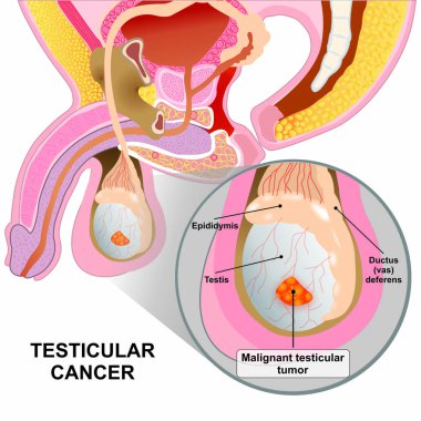 Kötü huylu testis kanseri Tıbbi çizim