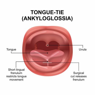 Bebeğin dil çiziminde Dil-bağı (Ankyloglossia)