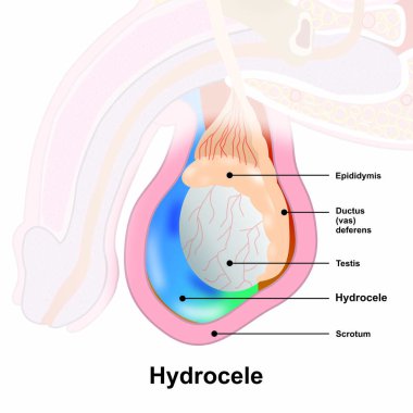 Hydrocele fluid-filled sac around testicle illustration
