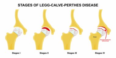 Legg Buzağı Perthes Hastalığının Aşamaları