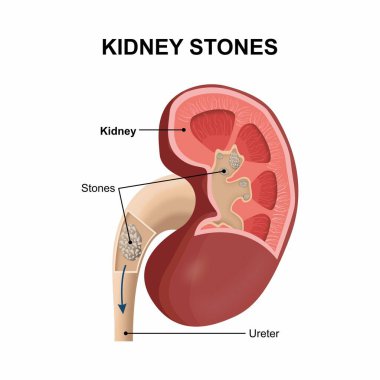 Böbrek taşı çizimi
