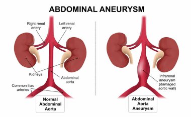 Abdominal Aort Anevrizması İllüstrasyon zayıf arter