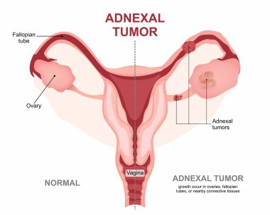 Adnexal Tümör Yumurtalıkları, Fallop Tüpleri İllüstrasyonu