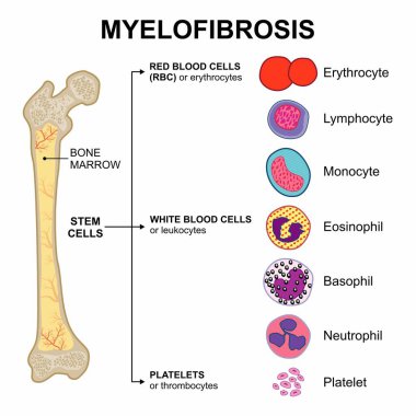 Myelofibrosis bone marrow blood cancer illustration clipart