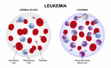Lösemi Kan Kanseri İllüstrasyonu