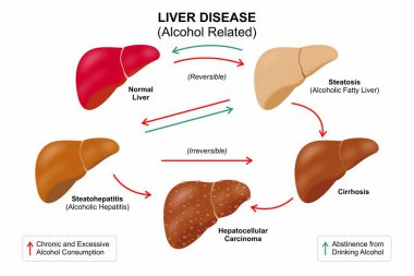 Alkolle İlgili Karaciğer Hastalığı İllüstrasyonu