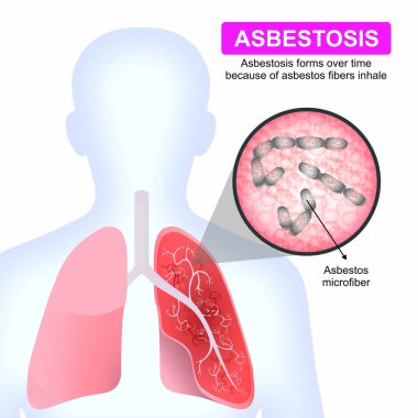Asbestoz soluyan asbest lifleri çizimi