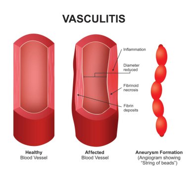 Vaskülit kan damarı kesiti çizimi