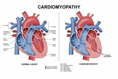Kardiyomiyopati Kalp Hastalıkları İllüstrasyon Bölümü