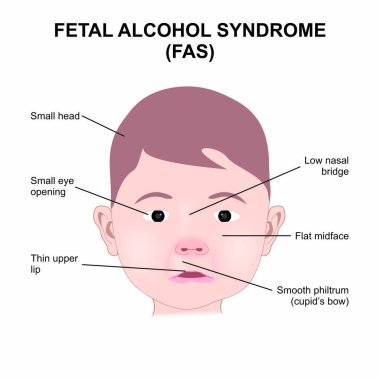 Fetal Alkol Sendromu (FAS) İllüstrasyon
