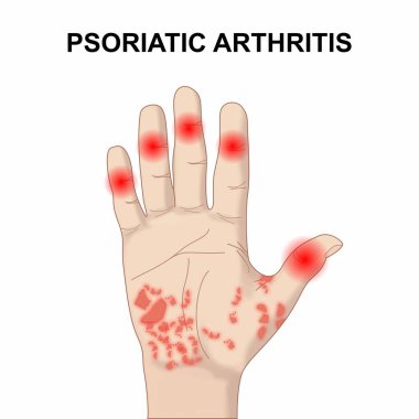 El illüstrasyonunda sedef iltihabı