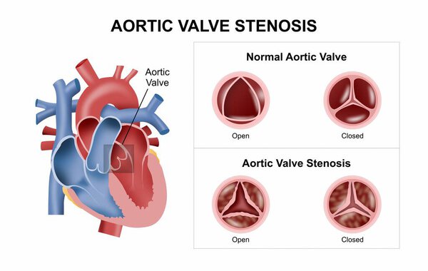 Стеноз аортального клапана