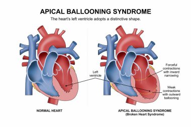 Apik Balon Sendromu (Kırık Kalp Sendromu) İllüstrasyon