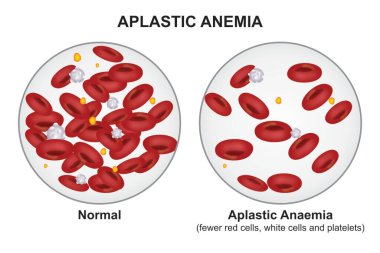 Aplastic Anemia blood disorder illustration clipart