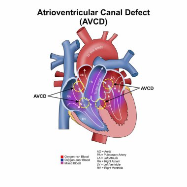 Atrioventriküler Kanal Bozukluğu (AVCD) İllüstrasyonu