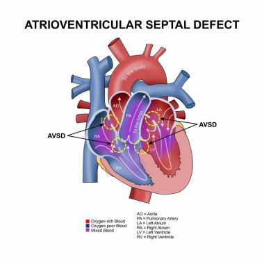 Atrioventriküler Septal Bozukluk (AVSD) İllüstrasyon