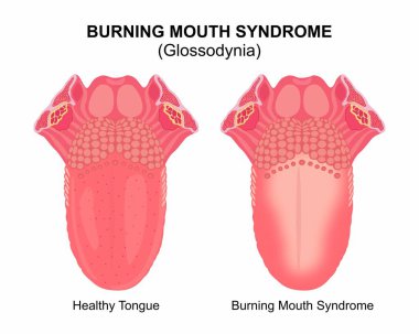 Burning Mouth Syndrome (Glossodynia) Illustration clipart