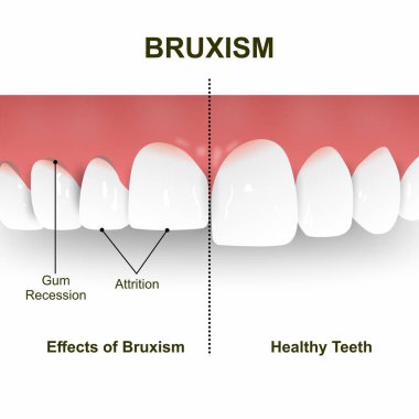 Bruxism Tooth Illustration, Normal vs Efekt of Bruxism