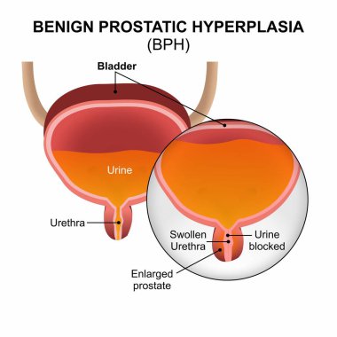 İyi huylu Prostatik Hiperplazma (BPH) İllüstrasyon