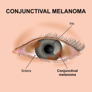 Konjonktival Melanoma nadir göz kanseri illüstrasyonu