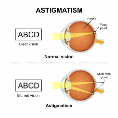 Göz Astigmatizmi bulanık görme illüstrasyonu