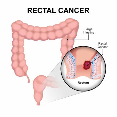 Rectal Cancer Rectum Cancer Illustration clipart