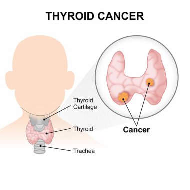 Tiroit kanseri, tümör illüstrasyon boynu