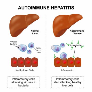 Otoimmün Hepatit Karaciğer Hastalığı İllüstrasyonu