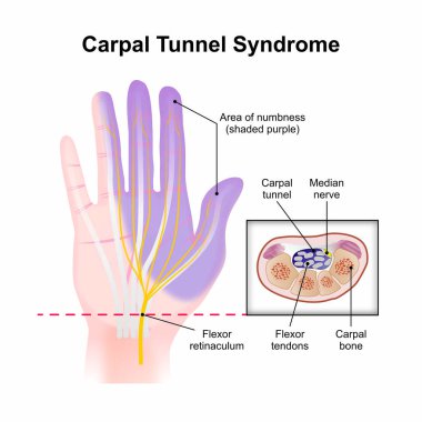 Karpal Tünel Sendromu El Çizimi