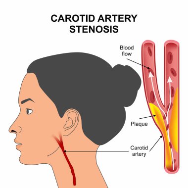 Karotid Arter Stenozu Tıbbi İllüzyon