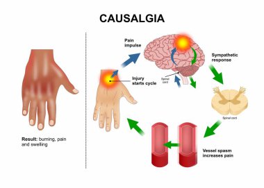 Causalgia (Karmaşık Bölgesel Ağrı Sendromu Tip II) İllüstrasyon