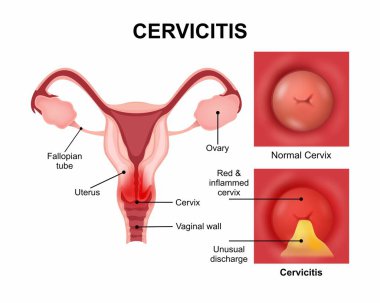 Rahim ağzı iltihabı. Rahim ağzı enfeksiyonları.