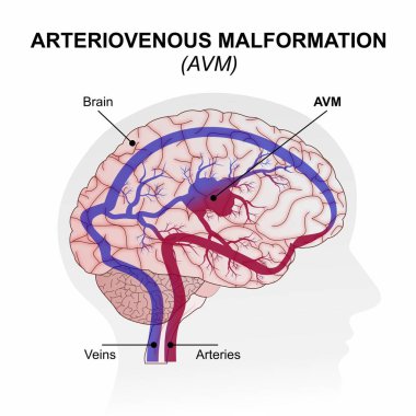 Arteriovenöz Malformasyon (AVM) Beyin Resimleri