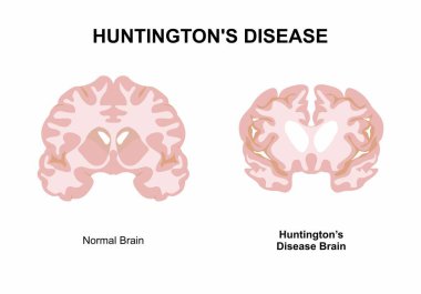 Huntington Hastalığı Beyin Bozukluğu Çizimi