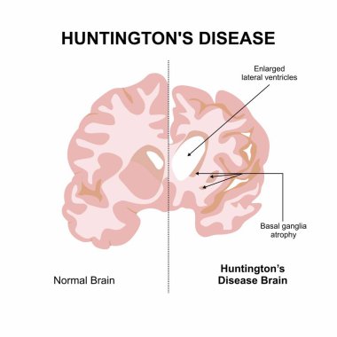 Huntington Hastalığı İllüstrasyon Beyin Bozukluğu