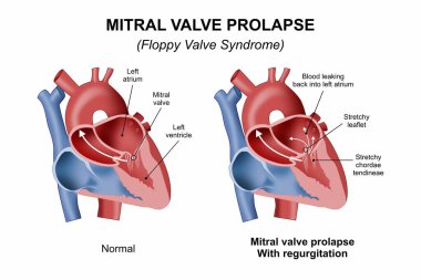Mitral Valf Prolapse - Disket Kapakçık Sendromu Kalp İllüstrasyonu