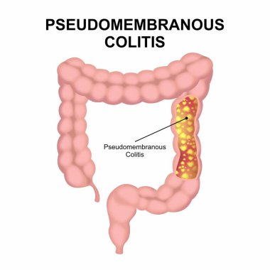 Pseudomembranous Colitis Illustration Human Colon