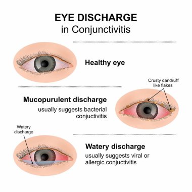 Conjunctivitis Illustration 'da göz boşalması