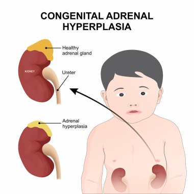 Doğuştan Adrenal Hiperplazi Böbrek İllüstrasyonu